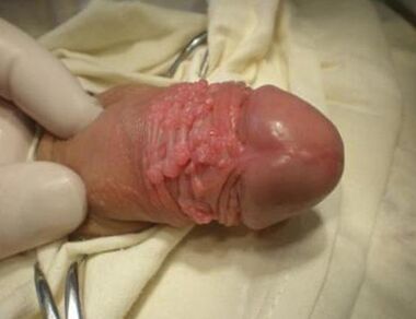 Papilloma σε ένα μέλος